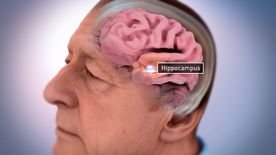 Alzheimer's brain shrinkage illustration NIA NIH