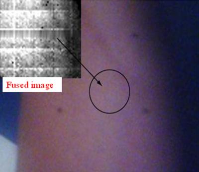 Image showing skin erythema