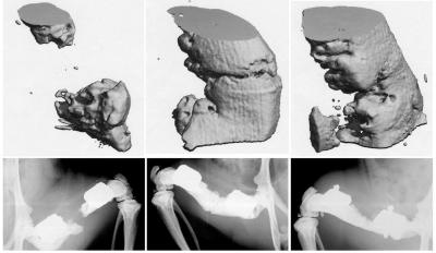 Bone regeneration with stem cell scaffold