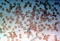 Sickled red blood cells