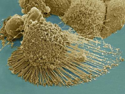 Dying cancer cell from NIH microscopy