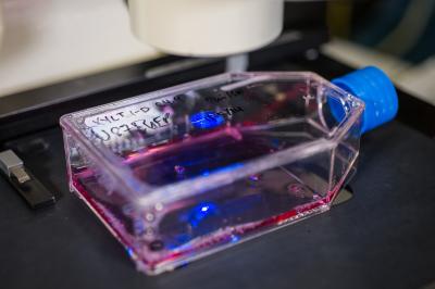 Glioblastoma sample3
