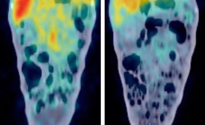 PET-CT Images