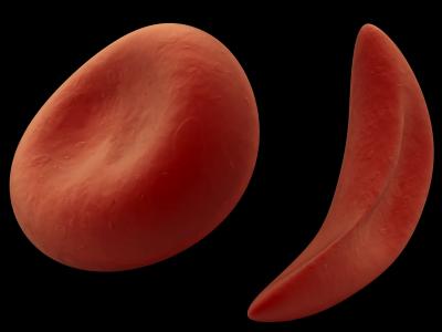 Sickle cell disease is a group of disorders that affects hemoglobin, the molecule in red blood cells that delivers oxygen to cells throughout the body.