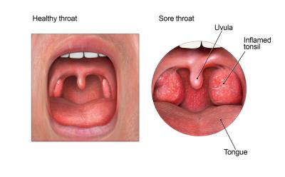 Sore throat illustration CDC