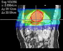 research Horizons - Treating Cancer - four-dimensional IMRT treatment plan