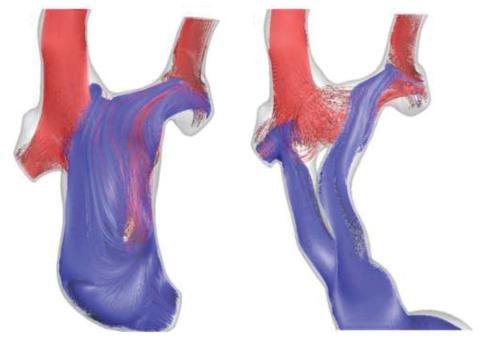 Fontan procedure Y-graft