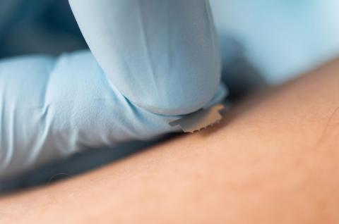 Microneedle patch on skin