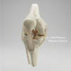image of a knee joint with meniscus implant