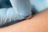 Microneedle patch on skin